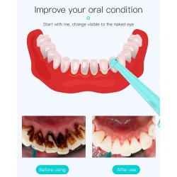 Elektrischer Zahnreiniger mit LED - NEUES MODELL - Entfernen Sie Plaque und Zahnstein zu Hause