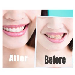 Tandblegning Strimler SmileKit Whitening Strips