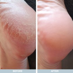 Australian Bodycare Foot Cream Cracked Heel Repair 500 ml.