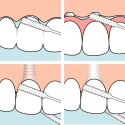 TePe Bridge &amp; Implant Floss Tandtrd