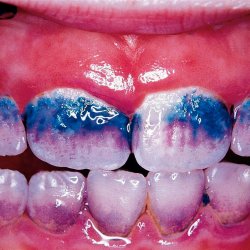 Plakkkontroll Fargelsning Miradent Mira-2-Ton 10 ml.