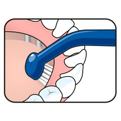 TePe Mono Tannbrste Universal Care Implant