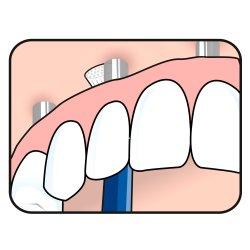 TePe Mono Tannbrste Universal Care Implant