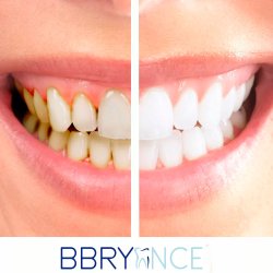 Tandblegning St Bbryance Whitening Kit